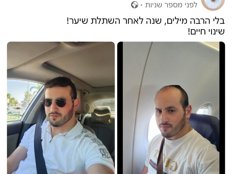 נתי רוקח | השתלת שיער | ע"י רופא מומחה | קפריסין