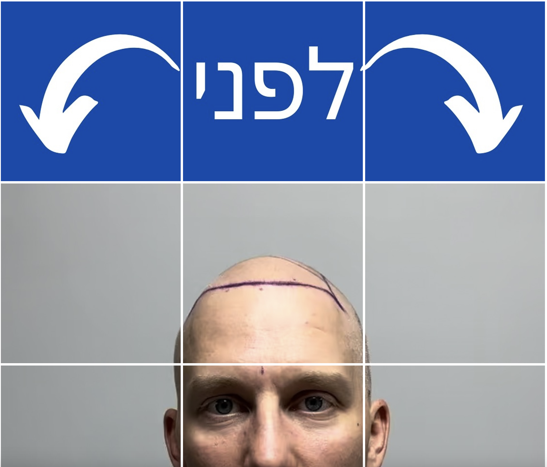 קו מושלם | השתלות שיער | קפריסין