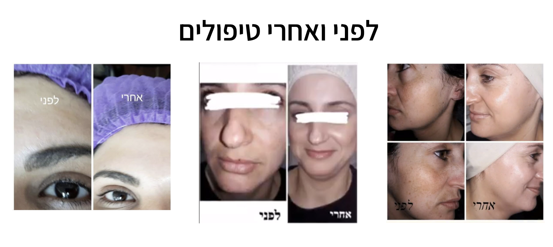 מכון אחווה | חגית הרפז | מומחית לטיפולי אקנה והסרת שיער | טיפולי פלזמה מתקדמים | קוסמטיקאית מומחית בירושלים